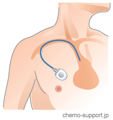 鎖骨下静脈にカテーテルを入れCVポート(リザーバー)本体を胸部に埋め込むイメージ