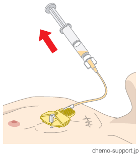 ヒューバー針（フーバー針）から血液の逆流を確認